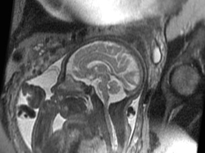 fetal mr